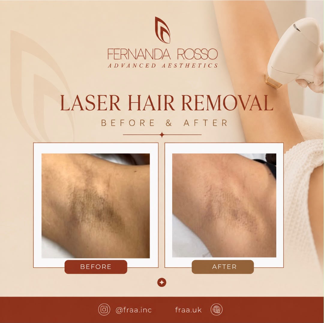 Laser hair removal before and after, underarm