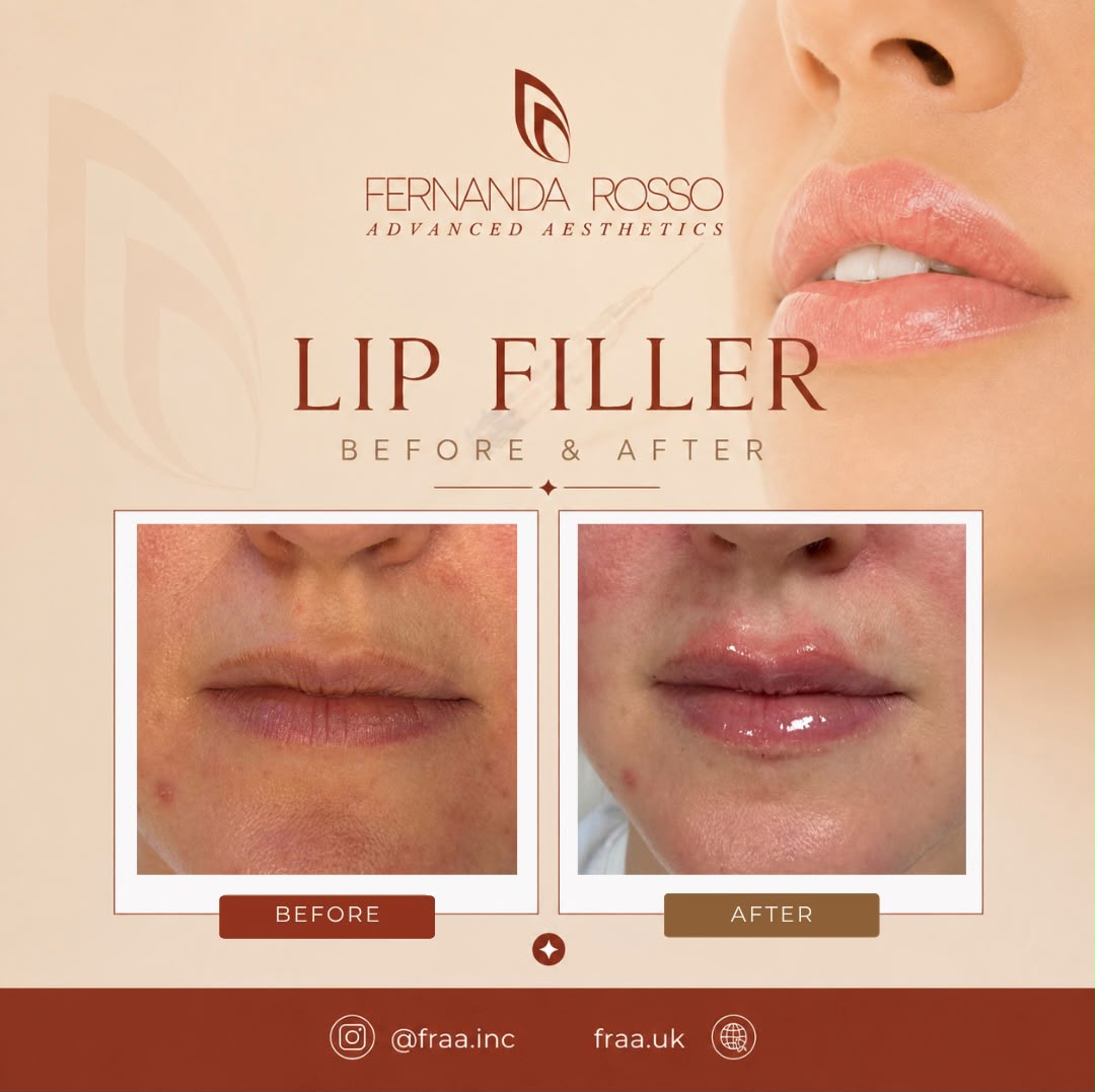 Lip filler before and after, front view of the lips