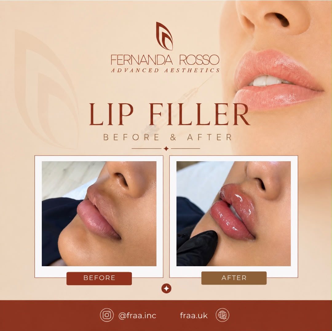 Lip filler before and after, three-quarter view of the lips