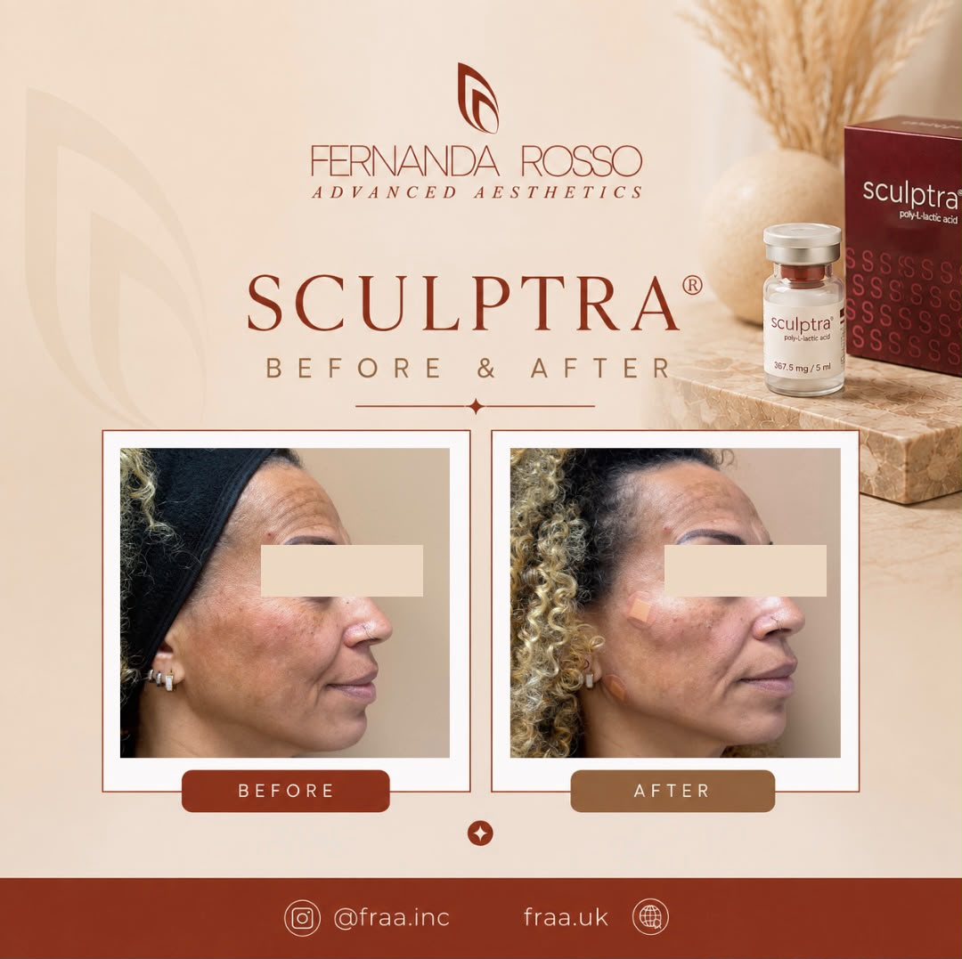 Sculptra before and after, side profile of the face