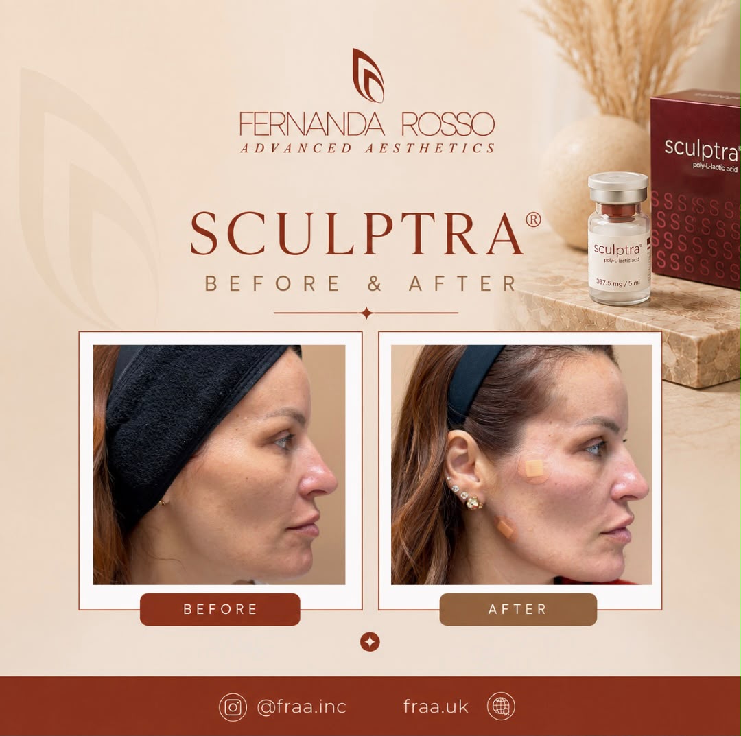 Sculptra before and after, side profile of the face