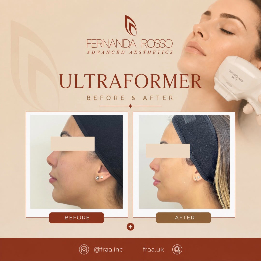 Ultraformer before and after, side profile of the jawline
