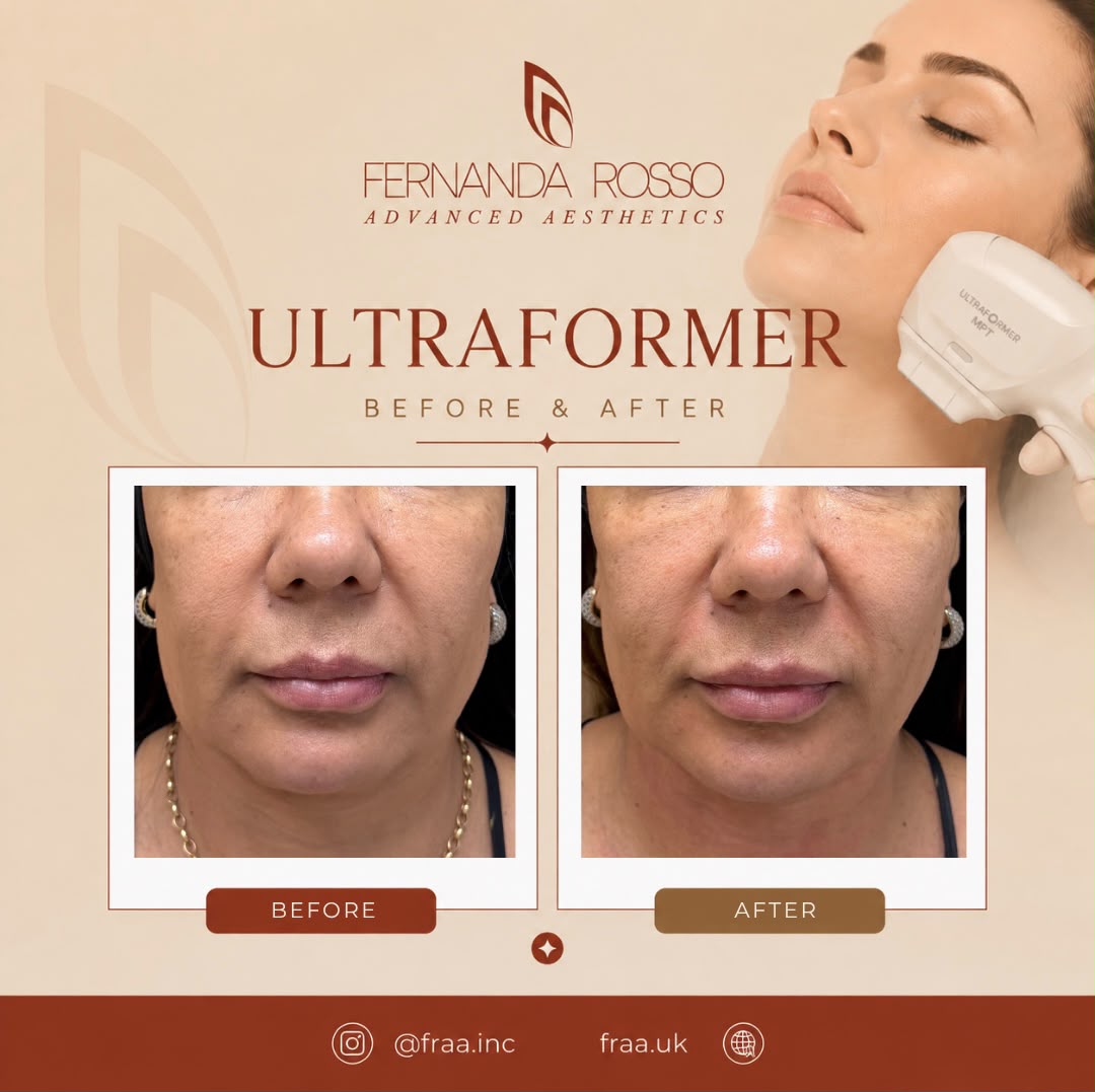 Ultraformer before and after, front view of the jawline