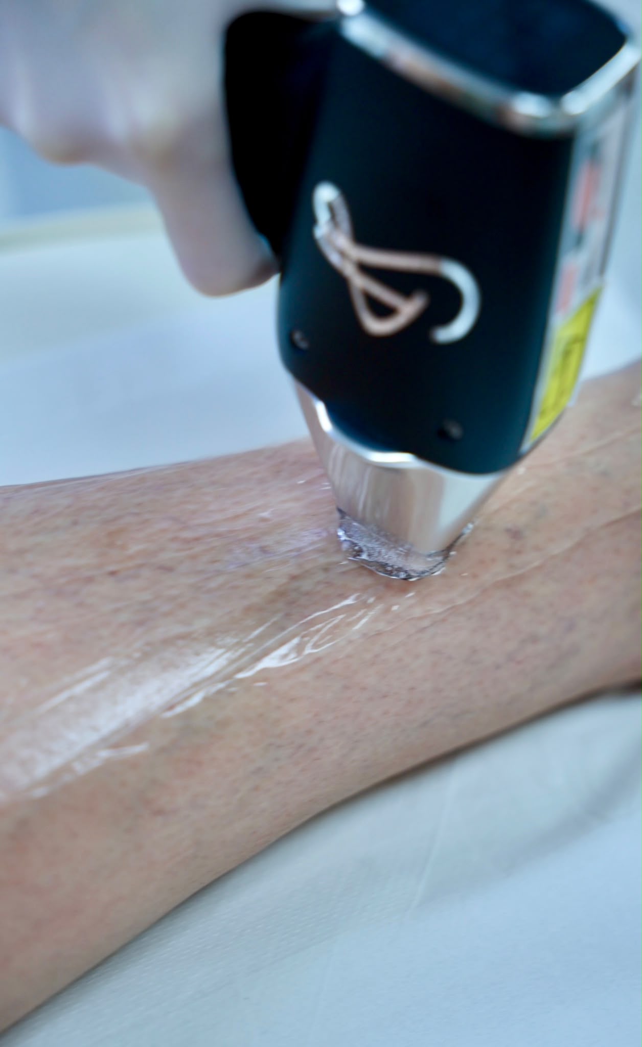 Laser treatment being applied to the arm